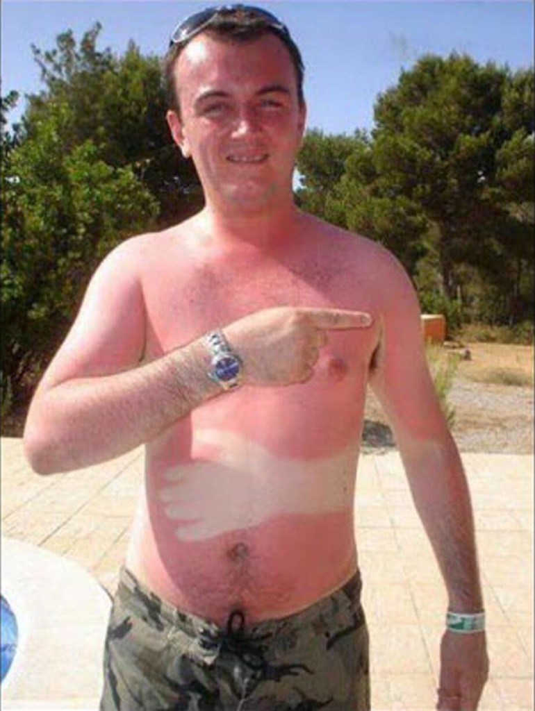 ££-Worst-And-Funniest-Sunburn-Ever (1)