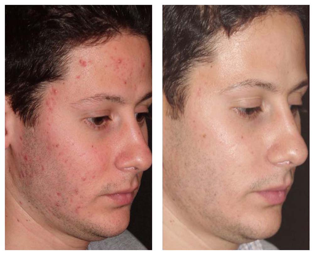 acne-face-before-and-after-i3