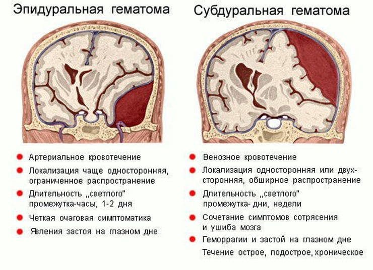 Сдавление мозга признаки. Субдуральное кровоизлияние головного мозга. Субдуральная и субарахноидальная гематома. Симптомы субдуральной гематомы. Сдавление головного мозга внутричерепными гематомами.
