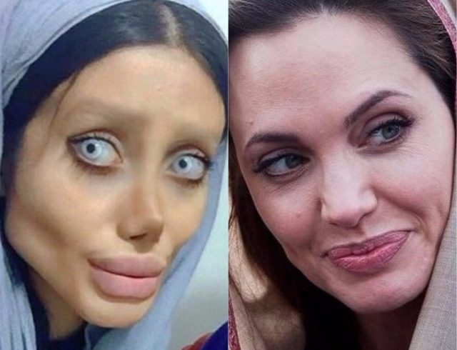 Жертва пластики: девушка изуродовала себя в погоне за внешностью Анджелины Джоли!