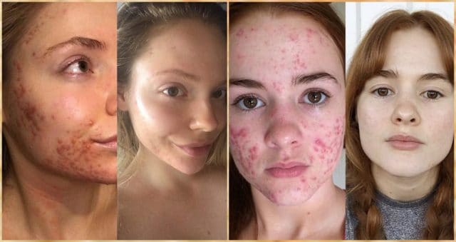 5 невероятных историй преображения девушек в борьбе с акне: НЕТ высыпаниям на лице!