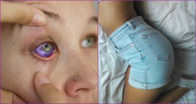 5 самых странных и жутких пластических операций: татуаж глазного яблока?!
