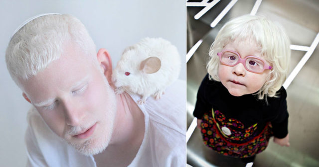 Особенные. Самые милые люди-альбиносы: 10 очаровательных фото