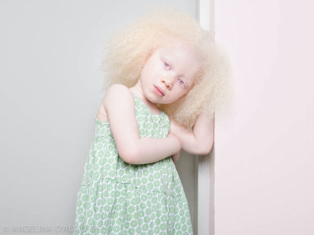 Девочка альбинос рис 2