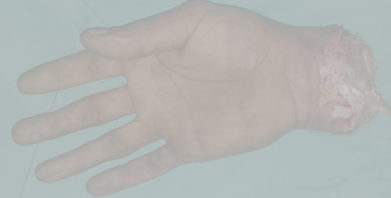ампутированная кисть руки