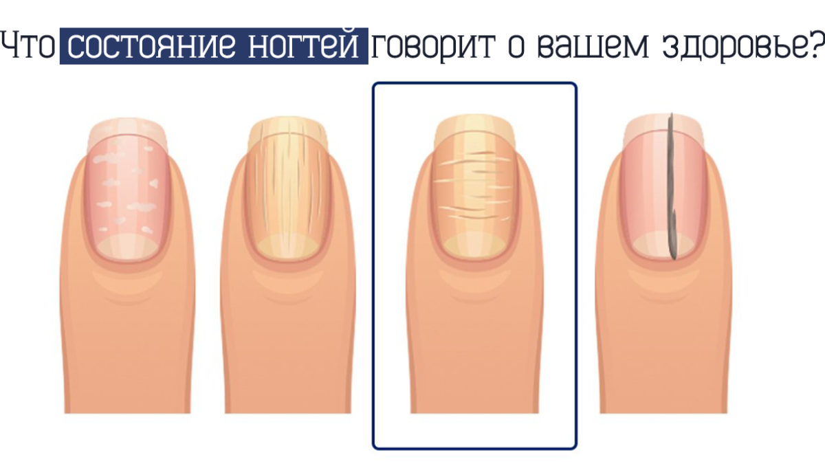 Полосы на ногтях вертикальные о чем говорят. Ногти состояние ногтей. О чём говорят ногти. Состачние здоровье по ногтям.