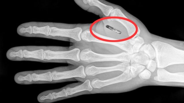 рентген кисти с чипом