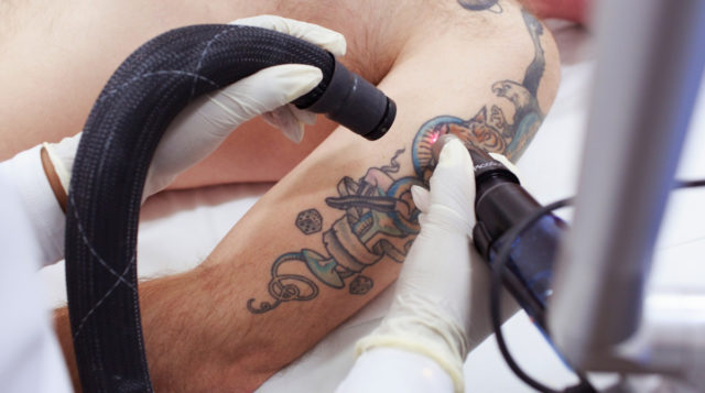 Удаление цветных татуировок неодимовым лазером