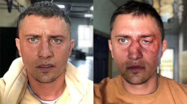 Павел Прилучный попал на операционный стол с травмами головы и лица