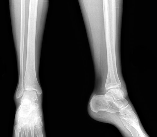рентгеновский снимок ног