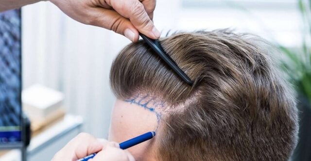 «Реально ли пересадить длинные волосы?», а также другие вопросы о пересадке волос и ответы на них
